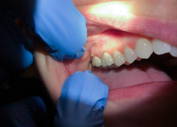 Best Urgent Care for Lost Fillings or Crowns in Crivitz, WI